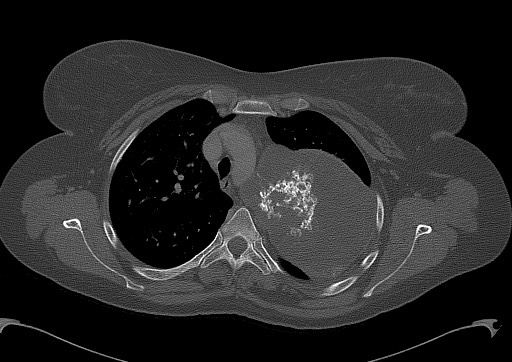 Chondrosarcoma - chest wall (Radiopaedia 65192-74199 Axial bone window 41).jpg