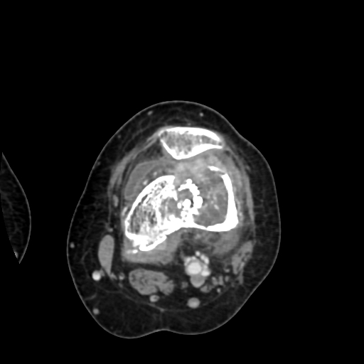 Chondrosarcoma - femur (Radiopaedia 64187-72954 Axial with contrast 39).jpg