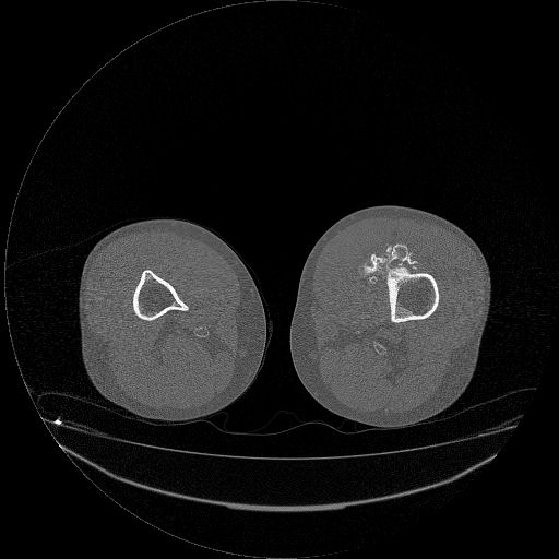 File:Chondrosarcoma arising from exostosis (Radiopaedia 59996-67507 Axial bone window 21).jpg