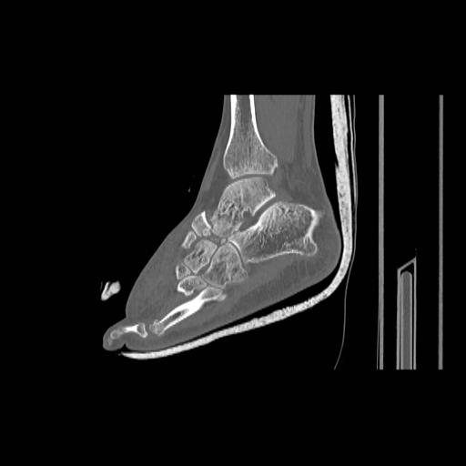 File:Chopart fracture (Radiopaedia 12386-12650 Sagittal bone window 12).jpg