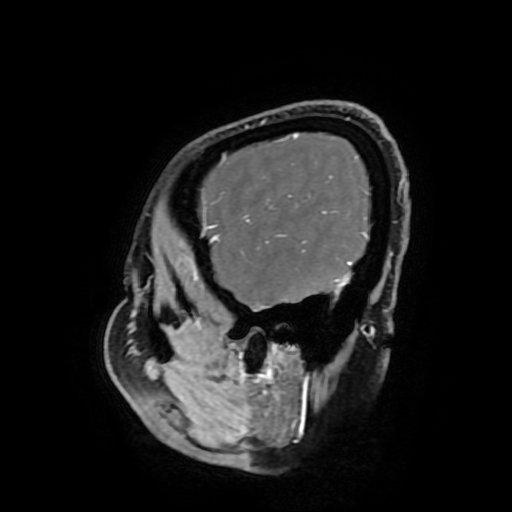 Chordoid glioma of third ventricle (Radiopaedia 91612-109340 F 177).jpg