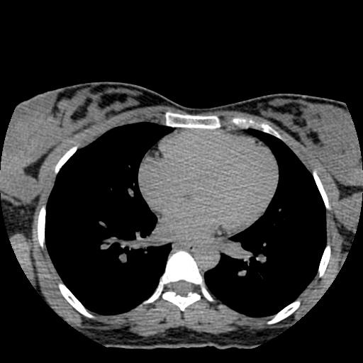 File:Choriocarcinoma of ovary with cerebral and pulmonary metastases (Radiopaedia 25983-26119 Axial non-contrast 153).jpg