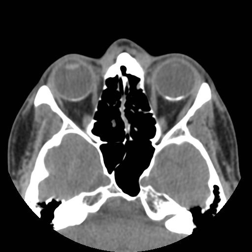 File:Choroidal osteoma (bilateral) (Radiopaedia 23284-23343 C 1).jpg