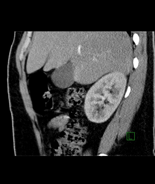 Chromophobe renal cell carcinoma (Radiopaedia 84255-99542 E 44).jpg