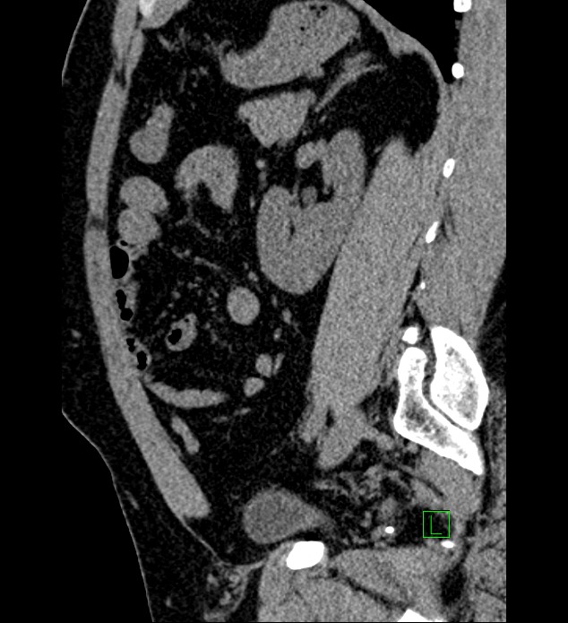 Chromophobe renal cell carcinoma (Radiopaedia 84286-99573 C 62).jpg