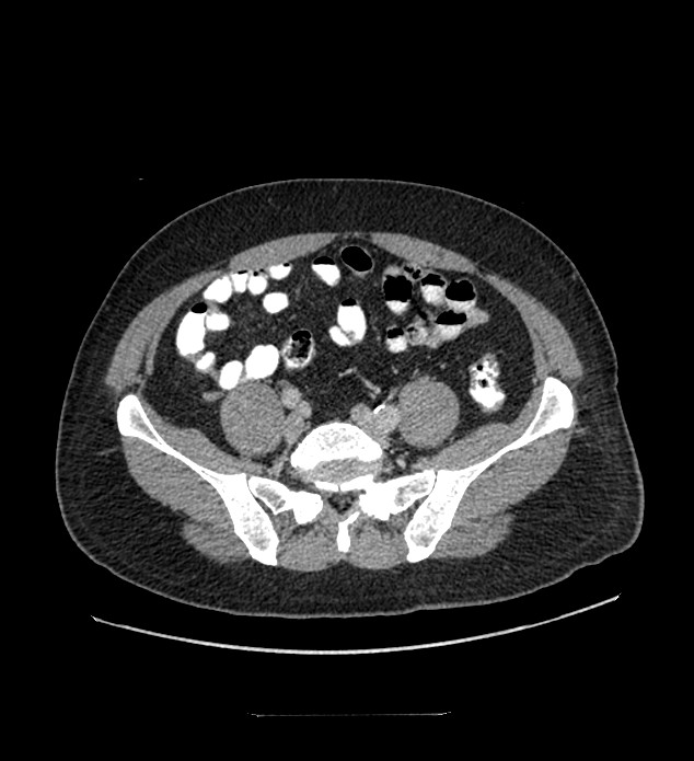 Chromophobe renal cell carcinoma (Radiopaedia 84337-99644 C 96).jpg