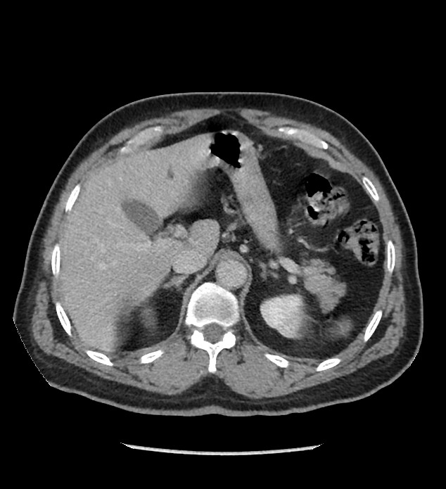 Chromophobe renal cell carcinoma (Radiopaedia 86879-103083 C 34).jpg