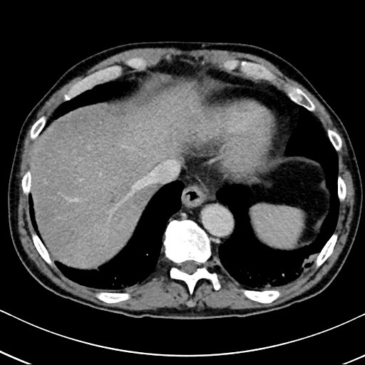 Chronic appendicitis complicated by appendicular abscess, pylephlebitis and liver abscess (Radiopaedia 54483-60700 B 26).jpg