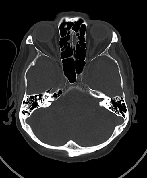 Chronic bilateral subdural hygroma (Radiopaedia 85801-101623 Axial bone window 91).jpg