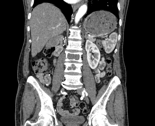 Chronic contained rupture of abdominal aortic aneurysm with extensive erosion of the vertebral bodies (Radiopaedia 55450-61901 D 46).jpg