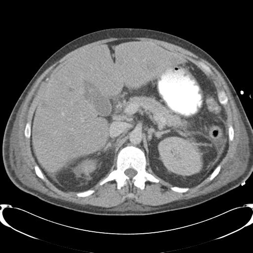 Chronic diverticulitis complicated by hepatic abscess and portal vein thrombosis (Radiopaedia 30301-30938 A 33).jpg