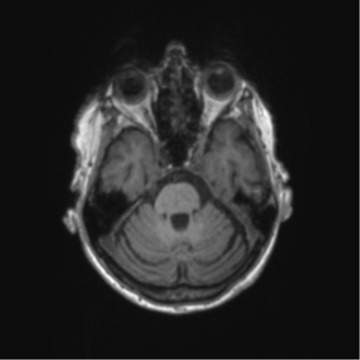 Chronic hypertensive encephalopathy (Radiopaedia 72844-83495 Axial T1 52).png