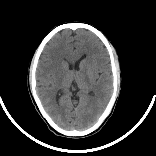 Chronic invasive fungal sinusitis with intraorbital and intracranial extension (Radiopaedia 56387-63046 Axial non-contrast 212).jpg