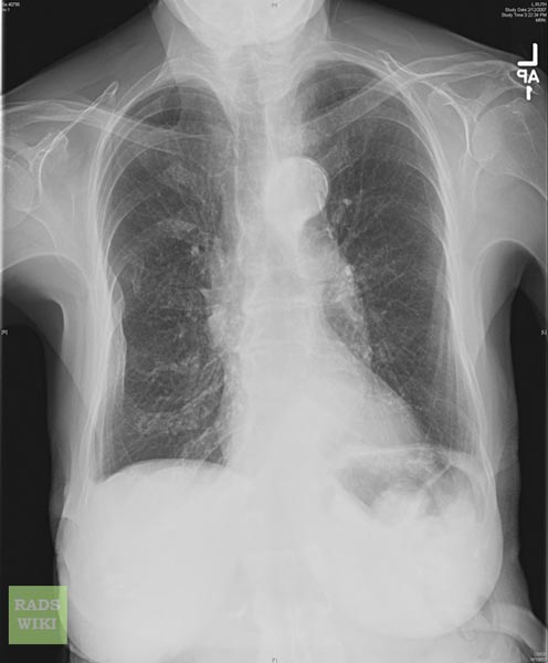 File:Chronic obstructive pulmonary disease (Radiopaedia 11311-11675 A 1).jpg