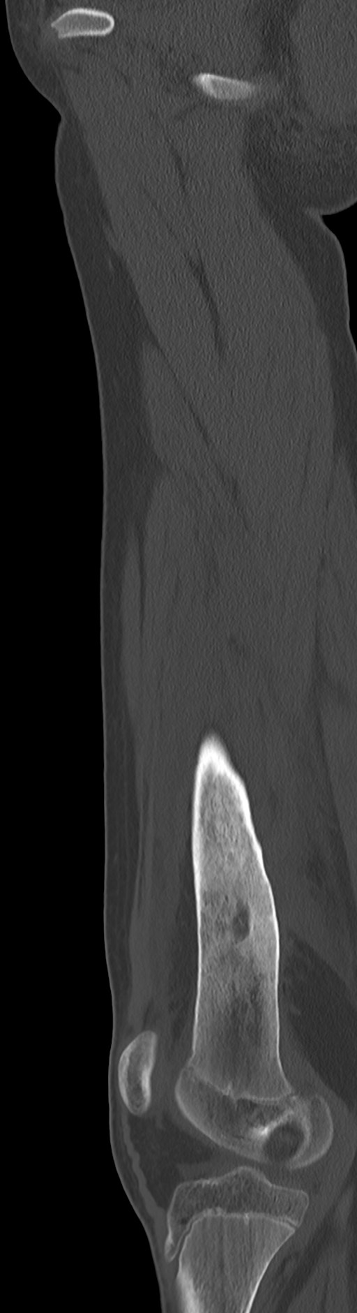 Chronic ostemyelitis of the femur with long sinus tract (Radiopaedia 74947-85982 Sagittal bone window 58).jpg