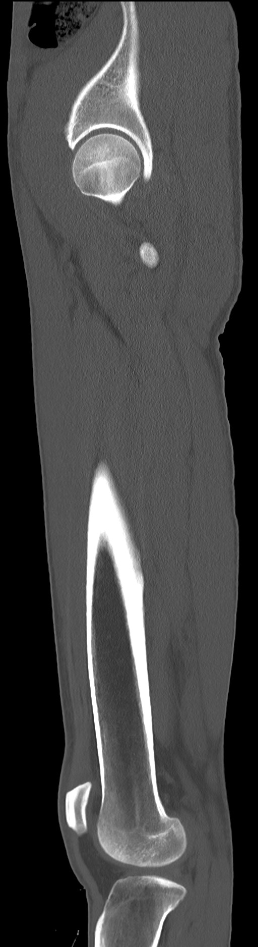 Chronic osteomyelitis (with sequestrum) (Radiopaedia 74813-85822 C 30).jpg