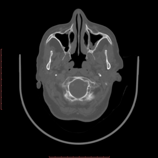 File:Chronic osteomyelitis - maxilla (Radiopaedia 23783-23927 Axial bone window 106).jpg