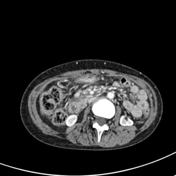 Chronic pancreatitis (Radiopaedia 55405-61846 A 49).jpg