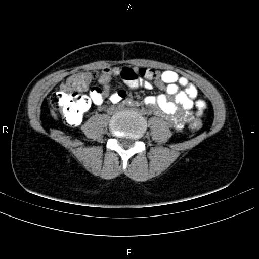 Chronic pancreatitis (Radiopaedia 64576-73450 Axial non-contrast 101).jpg