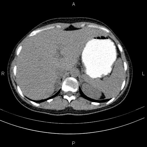Chronic pancreatitis (Radiopaedia 64576-73450 Axial non-contrast 25).jpg
