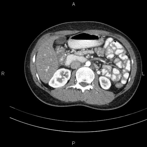 File:Chronic pancreatitis (Radiopaedia 64576-73450 B 69).jpg