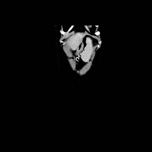 Chronic portal venous thrombosis with cavernous transformation (Radiopaedia 73618-84398 B 40).jpg