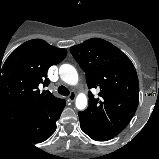 Chronic pulmonary embolism (Radiopaedia 73073-85094 Axial C+ CTPA 33).jpg