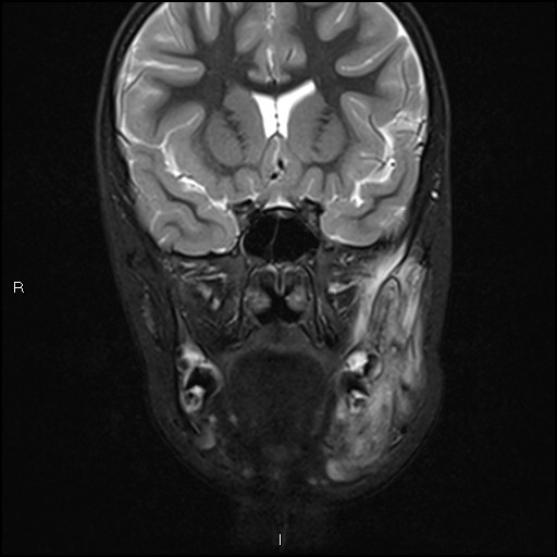 File:Chronic reactive multifocal osteomyelitis (CRMO) - mandible (Radiopaedia 56405-63069 Coronal STIR 16).jpg
