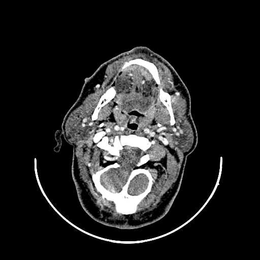 File:Chronic submandibular abscess (Radiopaedia 21738-21718 A 13).jpg