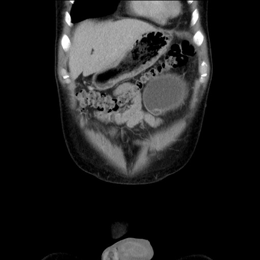Chronic ureteropelvic junction obstruction (Radiopaedia 78365-90996 B 21).jpg