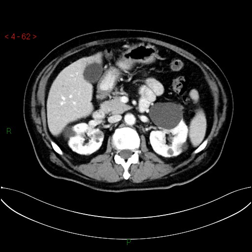 File:Circumaortic left renal vein and doubled left renal arteries (Radiopaedia 52268-58158 B 22).jpg