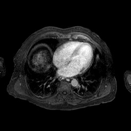 Cirrhosis and hepatocellular carcinoma in the setting of hemochromatosis (Radiopaedia 75394-86594 Axial T1 C+ fat sat 253).jpg
