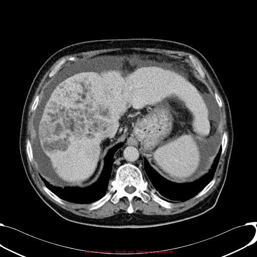 Cirrhosis and hepatocellular carcinoma in the setting of hemochromatosis (Radiopaedia 75394-86595 B 23).jpg