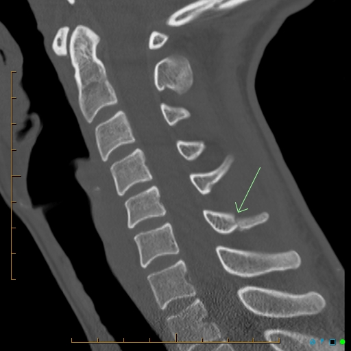 File:Clay-shoveler fracture (Radiopaedia 27426-27621 Sagittal bone window 1).jpg