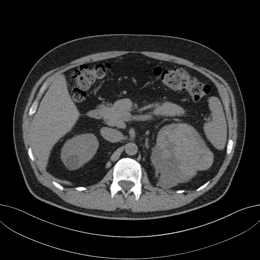 File:Clear cell renal cell carcinoma (Radiopaedia 61449-69393 Axial non-contrast 24).jpg