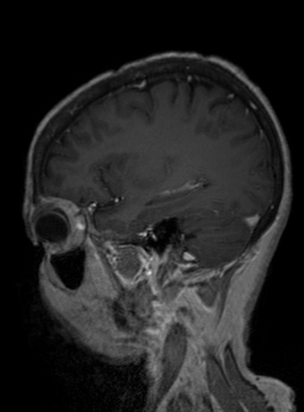 Clival meningioma (Radiopaedia 53278-59248 Sagittal T1 C+ 320).jpg