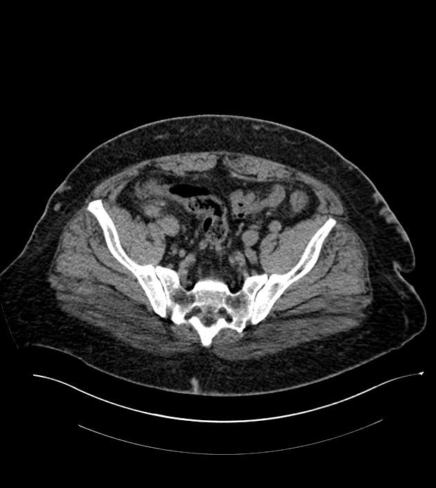 Closed-loop small bowel obstruction-internal hernia (Radiopaedia 78439-91096 Axial non-contrast 125).jpg