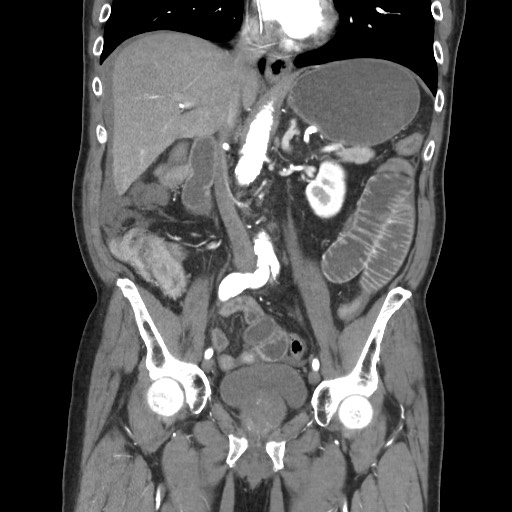 Closed loop obstruction due to adhesive band, resulting in small bowel ischemia and resection (Radiopaedia 83835-99023 C 65).jpg