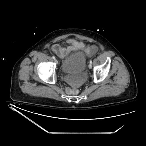 File:Closed loop obstruction due to adhesive band, resulting in small bowel ischemia and resection (Radiopaedia 83835-99023 D 136).jpg
