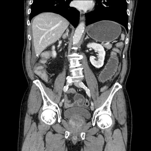 Closed loop obstruction due to adhesive band, resulting in small bowel ischemia and resection (Radiopaedia 83835-99023 E 73).jpg