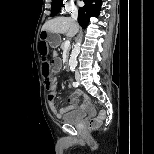 Closed loop obstruction due to adhesive band, resulting in small bowel ischemia and resection (Radiopaedia 83835-99023 F 91).jpg