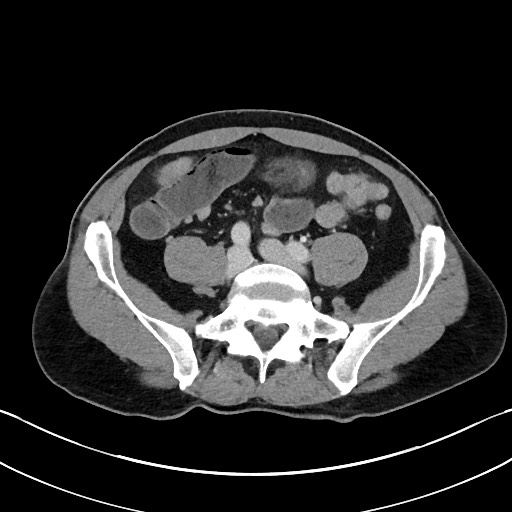 File:Closed loop small bowel obstruction - internal hernia (Radiopaedia 57806-64778 B 86).jpg