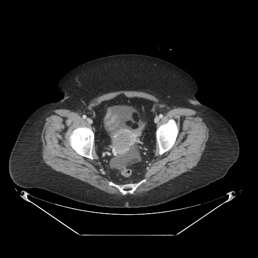 File:Closed loop small bowel obstruction - internal hernia (Radiopaedia 65402-74450 A 119).jpg