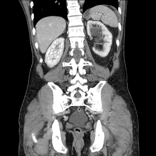 Closed loop small bowel obstruction - omental adhesion causing "internal hernia" (Radiopaedia 85129-100682 B 94).jpg