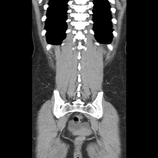 File:Closed loop small bowel obstruction due to trans-omental herniation (Radiopaedia 35593-37109 B 44).jpg