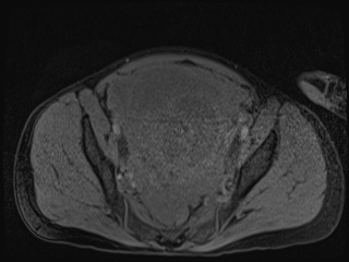Closed loop small bowel obstruction in pregnancy (MRI) (Radiopaedia 87637-104031 G 3).jpg