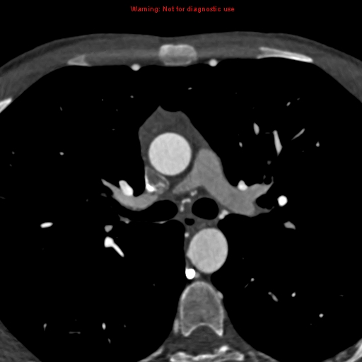 File:Coarctation of the aorta (Radiopaedia 12461-12697 A 170).jpg
