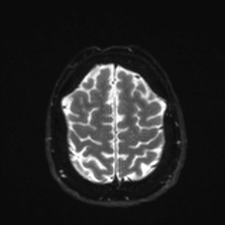Cochlear incomplete partition type III associated with hypothalamic hamartoma (Radiopaedia 88756-105498 Axial DWI 35).jpg
