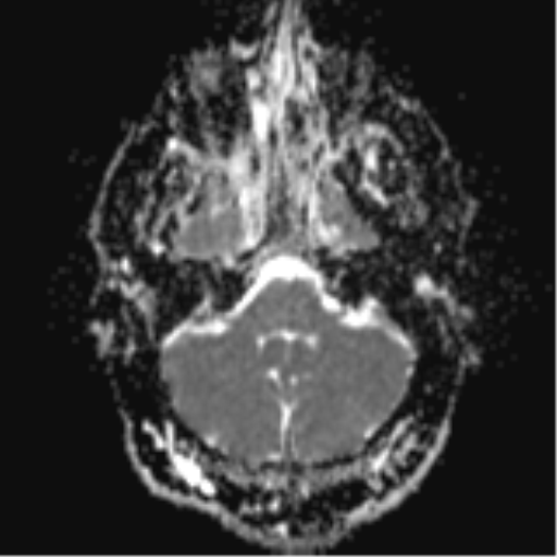 File:Colloid cyst (Radiopaedia 44510-48181 Axial ADC 6).png