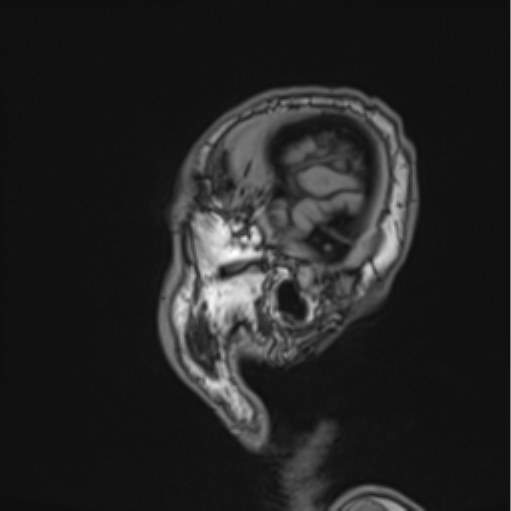 Colloid cyst of the third ventricle (Radiopaedia 86571-102662 Sagittal T1 7).png